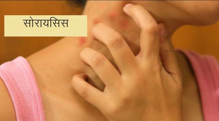 सोराइसिस