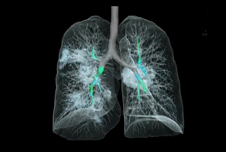 COVID-19 से संक्रमित फेफड़े की पहली 3D इमेज
