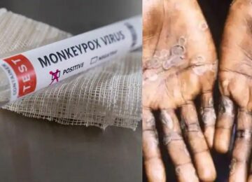 Monkeypox