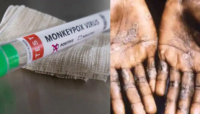 Monkeypox