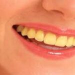 Yellow-Teeth