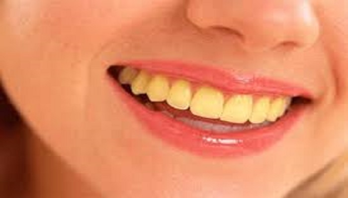 Yellow-Teeth