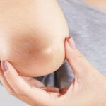 dark-elbow