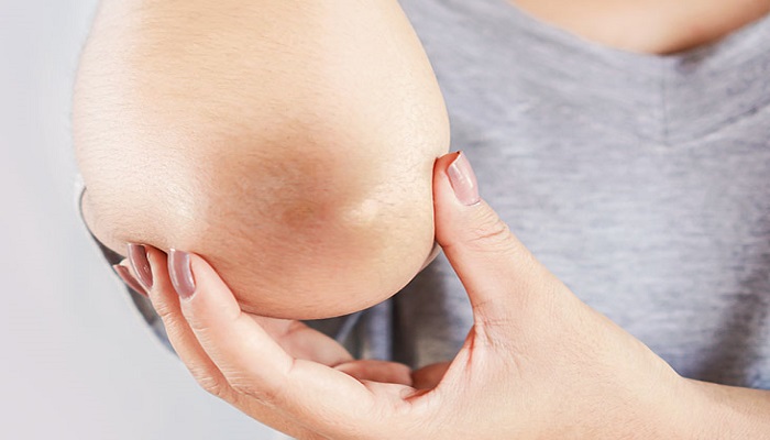 dark-elbow
