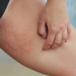 inner-thigh-rash