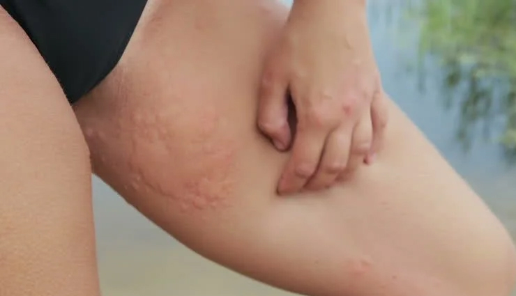 inner-thigh-rash