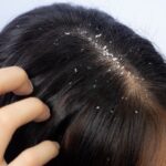 dandruff