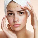 remedies-for-pimples