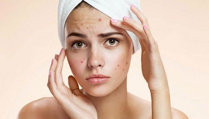remedies-for-pimples