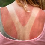 sunburn