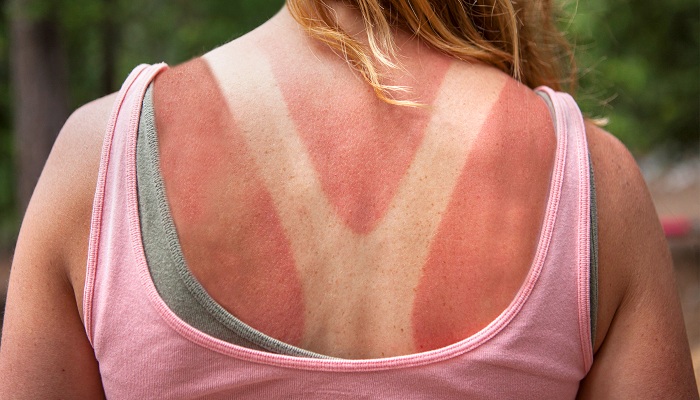 sunburn