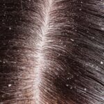 Dandruff