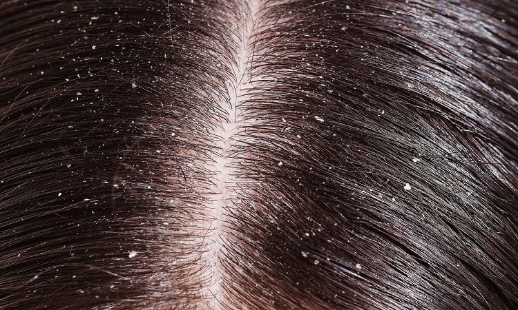 Dandruff