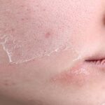 Dry-Skin