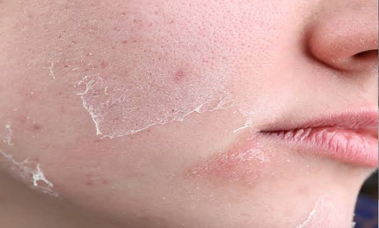 Dry-Skin