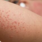 Heat-Rash-1