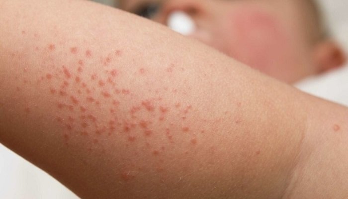 Heat-Rash-1