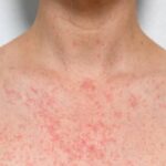 Heat-Rash