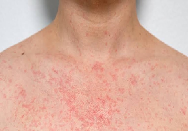 Heat-Rash