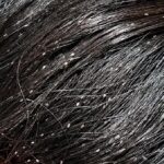 Lice