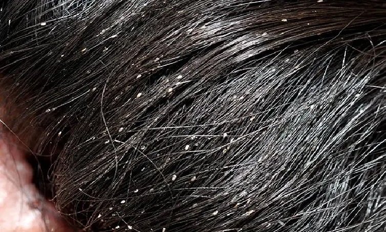 Lice