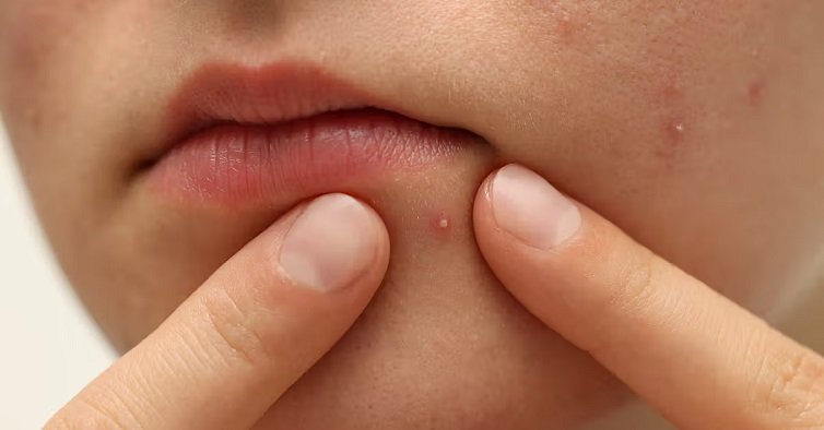 Pimples