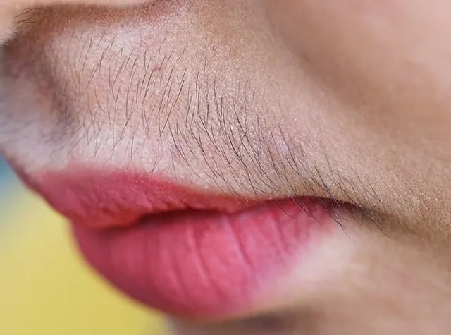 Unwanted-Hair