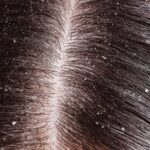 Dandruff