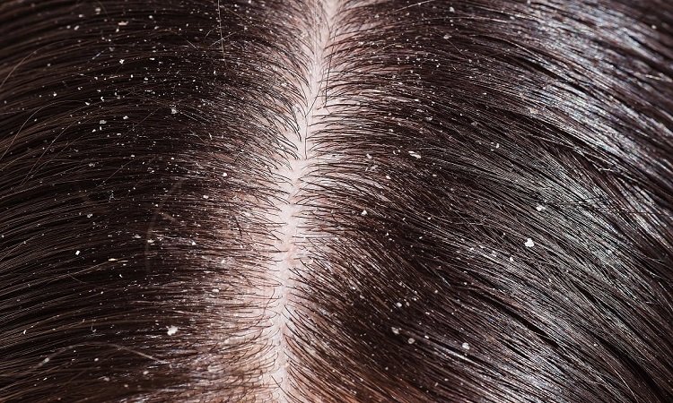 Dandruff