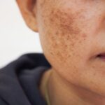 Pigmentation